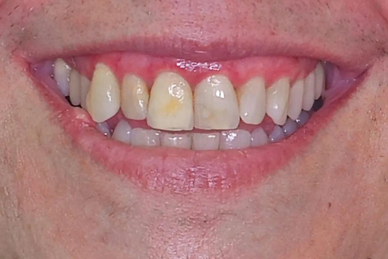 Clear aligner progress before treatment