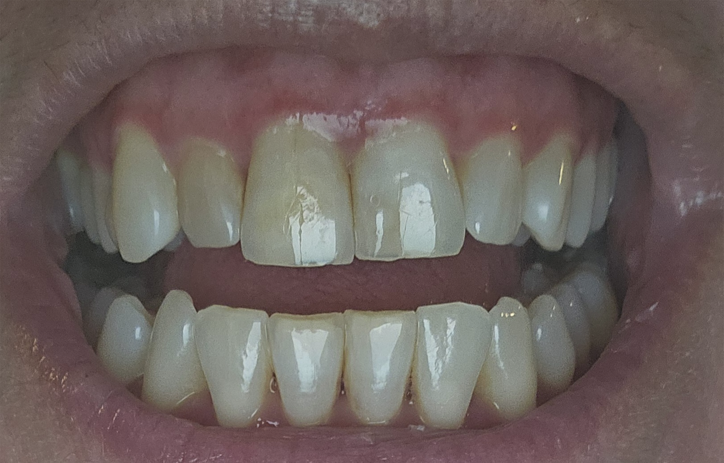 Clear aligner progress at tray 4