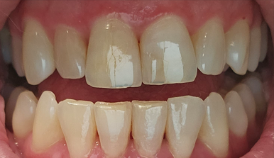 Clear aligner progress at tray 7